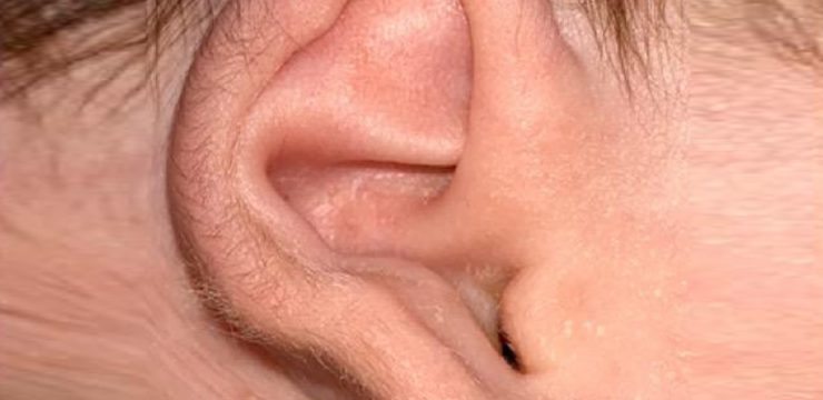 baby ear deformities
