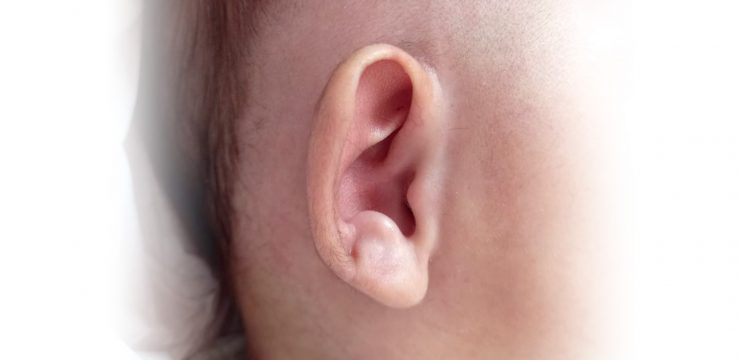 prominent ear